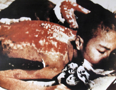 Thermal Radiation Heat Burns. This boy was exposed to thermal radiation approximately 2km from the Nagasaki hypocenter. Photograph by U.S. Army, November 1945.