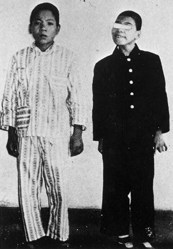 Microcephaly due to in-utero exposure (seven week gestation in estimate). Exposure distance of 1.2km from Nagasaki hypocenter. Delayed grown in whole body and microcephaly observed (right). Fifteen years and eight months old. Died March 1962. Twelve year old normal child (left).