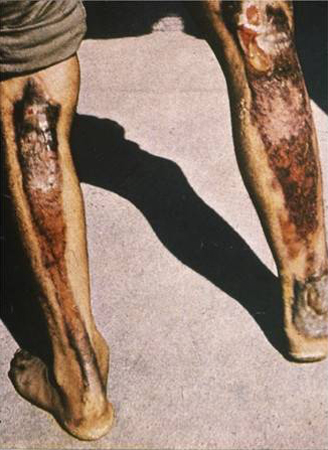 Third-degree localized burns of skin exposed at about one mile from ground zero.